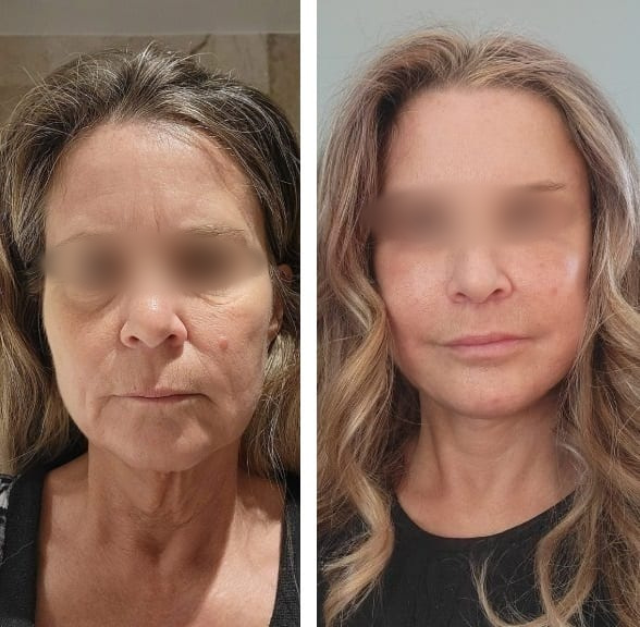 Lifting Facial y Cuello caso 3 — antes y después